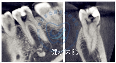 根充病例